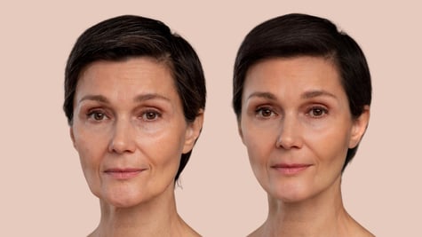 antes vs despues exosomas