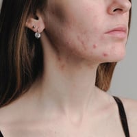 desequilibrio hormonal acne