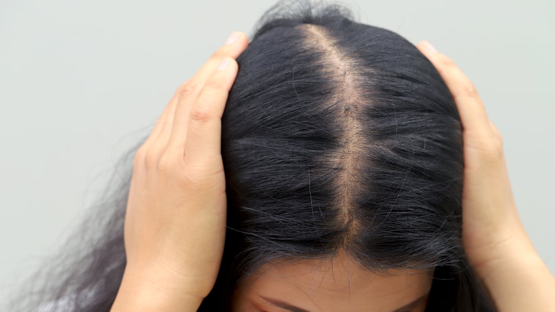 perdida de pelo