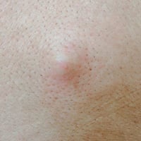 proliferacion bacteriana acne