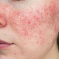 rosacea